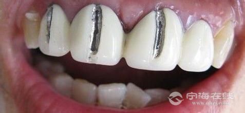 萎缩等,在没有治疗的情况下安装烤瓷牙导致一系列问题的应该尽快拆除