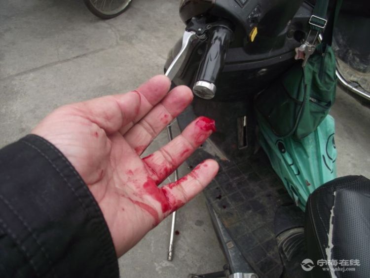 我的手指血肉模糊