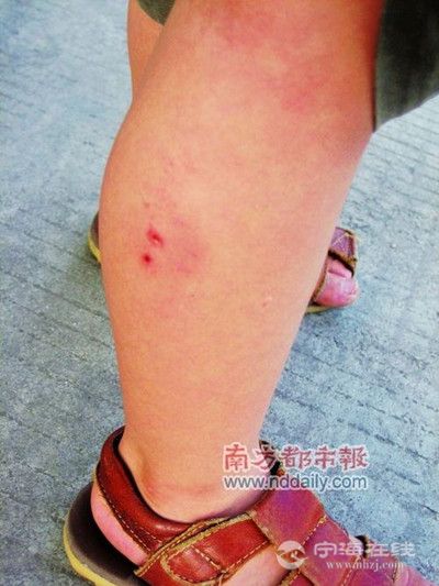 宁海今年每月平均500多人被咬伤