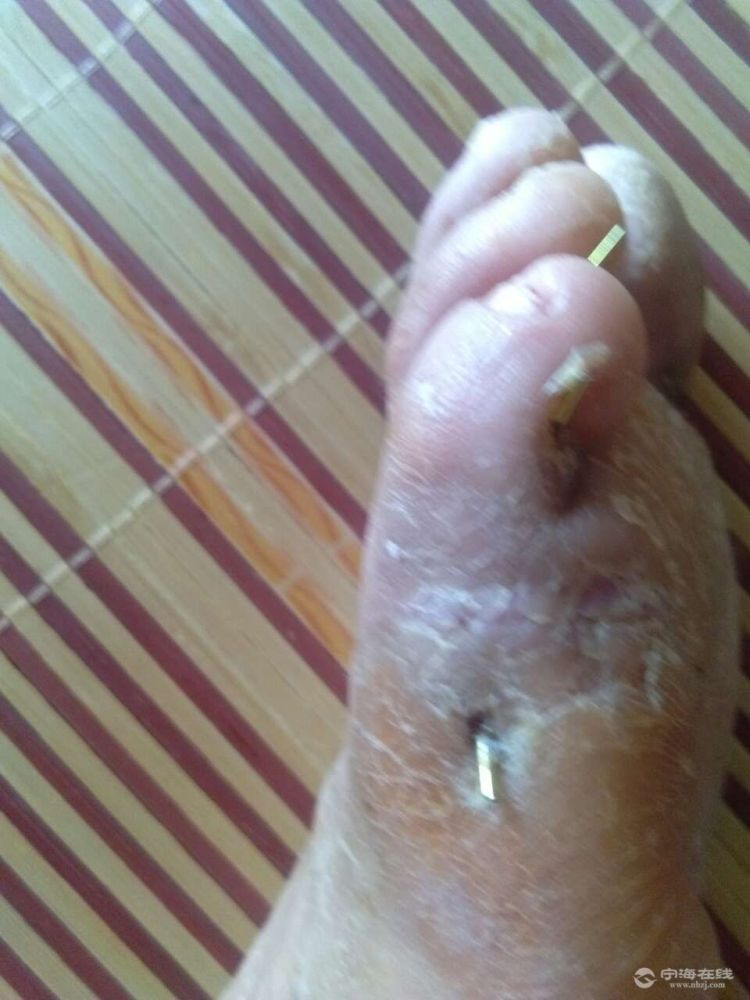 右足压砸伤1,右足第5趾近节,未节趾骨骨折2,右足第5趾皮肤挫裂伴血管